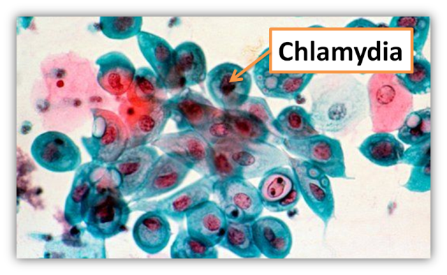 chlamydia